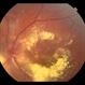 Hypertensive Retinopathy Hypertensive Retinopathy